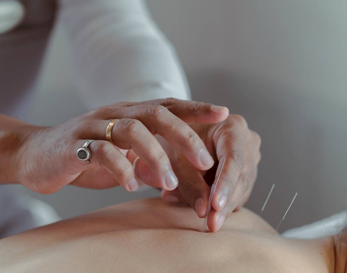 Eine Person, die eine Akupunkturbehandlung im Amatara Welleisure Resort durchführt.