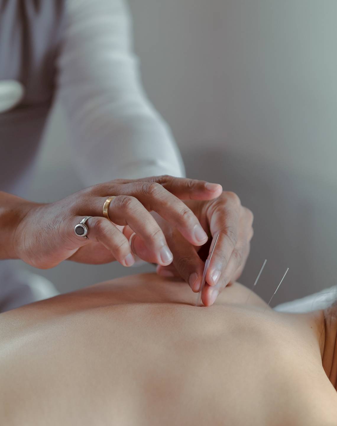 Eine Person, die eine Akupunkturbehandlung im Amatara Welleisure Resort durchführt.